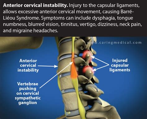 cervical compression vertigo test|does cervical stenosis cause dizziness.